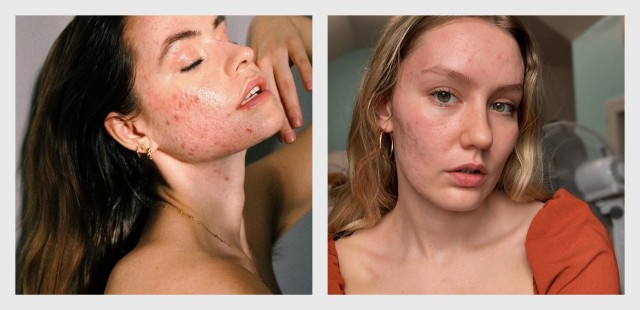 5 influencers που εκπροσωπούν το acne-positive κίνημα και αγαπούν το δέρμα τους με τις ατέλειες του